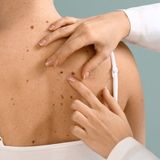 Wideodermatoskopia + konsultacja dermatologa