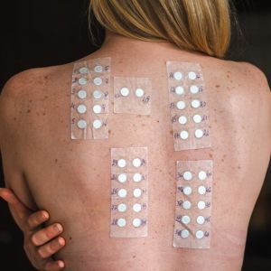 Patch contact tests – European standard