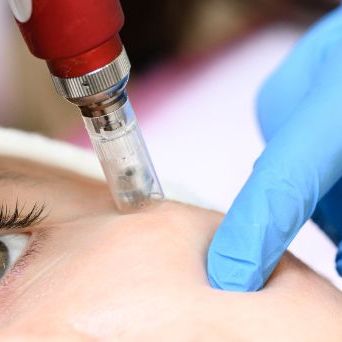 Microneedling of the eye area