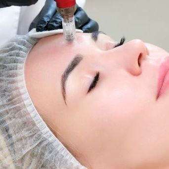 Microneedling of the skin of the face, neck and décolleté